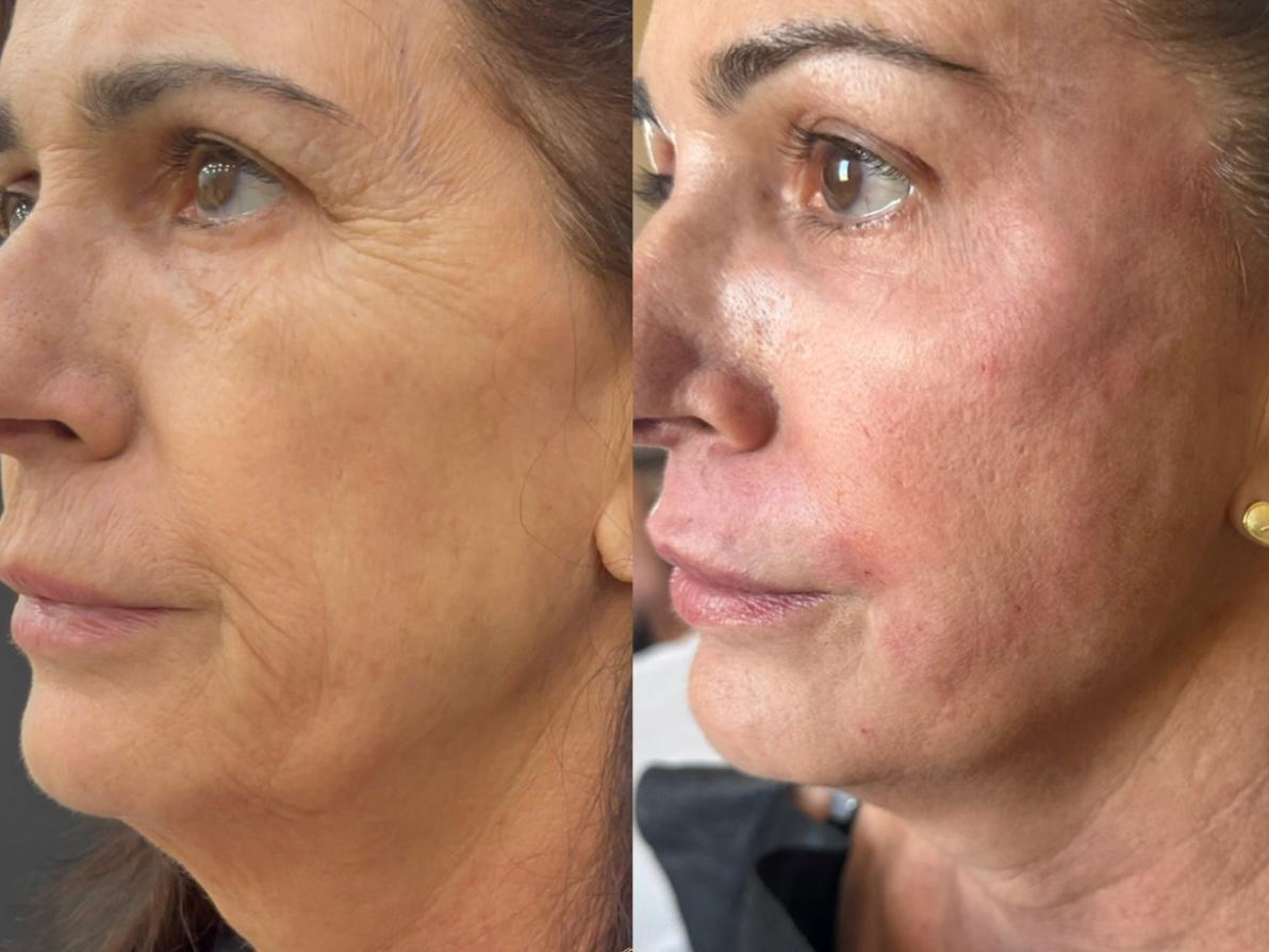 BioLift RP - Rejuvenescimento com Sustentacao